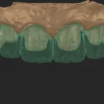 Micro-layering in modern dentistry: aesthetics, precision, and technological evolution using the CERABIEN MiLai system as an example