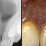 Movimiento adaptativo y cbct en endodoncia