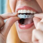 Integration of CBCT and outcome simulations: international accessibility and transformation of aligner treatment planning
