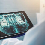 Artificial Intelligence in Oral Screening: Detection of Hidden Caries and Redefining Epidemiological Standards